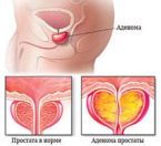Аденома предстательной железы