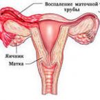 Аднексит