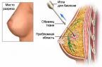 Пункция молочной железы